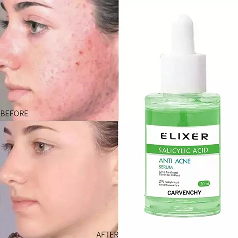 Anti-acne Soothing And Hydrating Skin Lotion